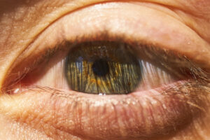 Glaucoma secundário