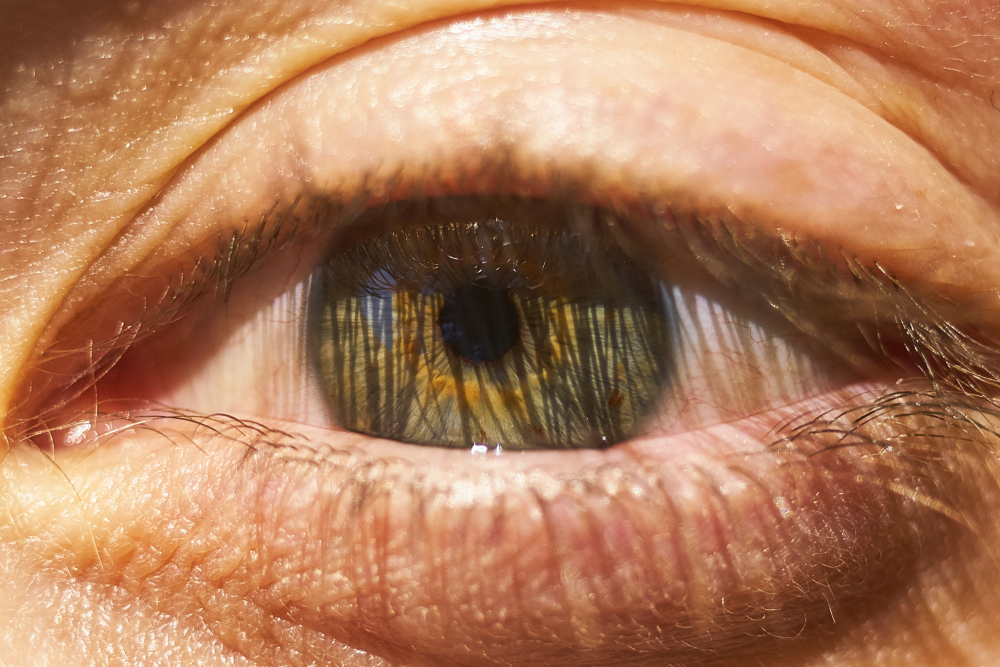 Glaucoma secundário