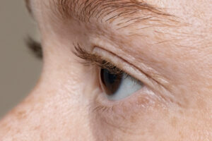 Suspeito de glaucoma